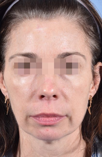 Fillers Before and After - Case 14, Image 1 - Female, age 35 – 44 - Baltimore, MD - Skin Therapeutics Med Spa