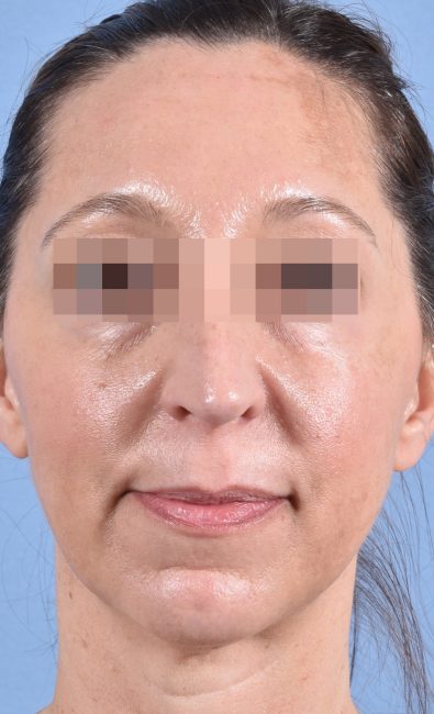 Fillers Before and After - Case 15, Image 1 - Female, age 35 – 44 - Baltimore, MD - Skin Therapeutics Med Spa