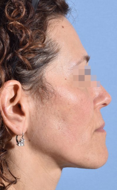 Fillers Before and After - Case 16, Image 1 - Female, age 35 – 44 - Baltimore, MD - Skin Therapeutics Med Spa