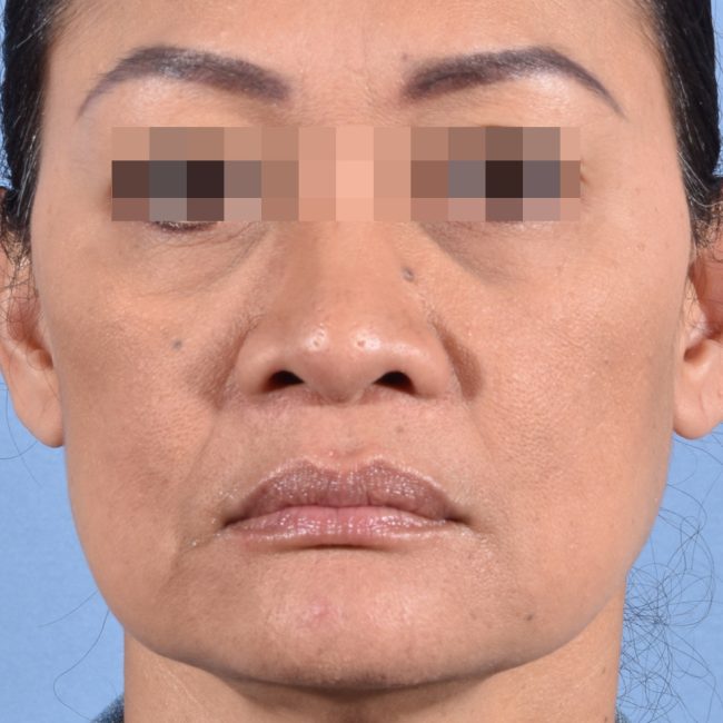 Fillers Before and After - Case 17, Image 1 - Female, age 35 – 44 - Baltimore, MD - Skin Therapeutics Med Spa