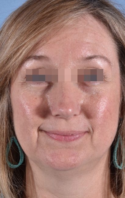 Fillers Before and After - Case 18, Image 1 - Female, age 35 – 44 - Baltimore, MD - Skin Therapeutics Med Spa