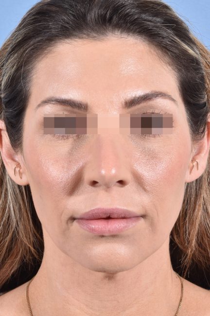 Fillers Before and After - Case 19, Image 1 - Female, age 25 – 34 - Baltimore, MD - Skin Therapeutics Med Spa