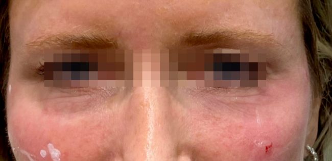 Fillers Before and After - Case 20, Image 1 - Female, age 35 – 44 - Baltimore, MD - Skin Therapeutics Med Spa