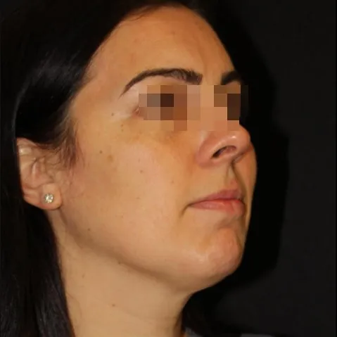 Fillers Before and After - Case 21, Image 1 - Female, age 25 – 34 - Baltimore, MD - Skin Therapeutics Med Spa