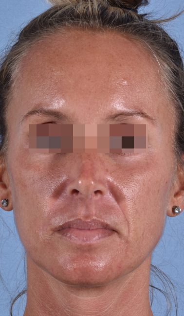 Fillers Before and After - Case 26, Image 1 - Female, age 25 – 34 - Baltimore, MD - Skin Therapeutics Med Spa