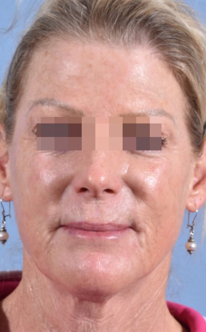 Fillers Before and After - Case 27, Image 1 - Female, age 45 – 54 - Baltimore, MD - Skin Therapeutics Med Spa