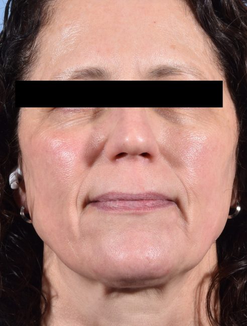 Fillers Before and After - Case 28, Image 1 - Female, age 45 – 54 - Baltimore, MD - Skin Therapeutics Med Spa