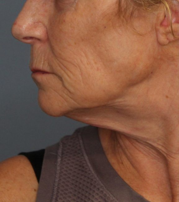 Fillers Before and After - Case 31, Image 1 - Female, age 45 – 54 - Baltimore, MD - Skin Therapeutics Med Spa