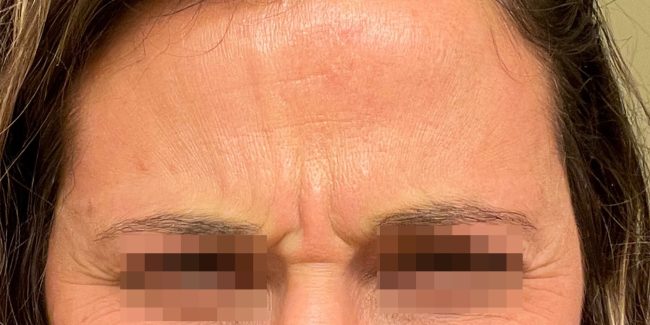 Dysport Before and After - Case 5, Image 1 - Female, age 25 – 34 - Baltimore, MD - Skin Therapeutics Med Spa