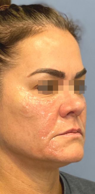 Fillers Before and After - Case 33, Image 1 - Female, age 35 – 44 - Baltimore, MD - Skin Therapeutics Med Spa