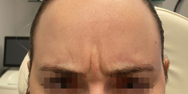 Dysport Before and After - Case 6, Image 1 - Female, age 25 – 34 - Baltimore, MD - Skin Therapeutics Med Spa