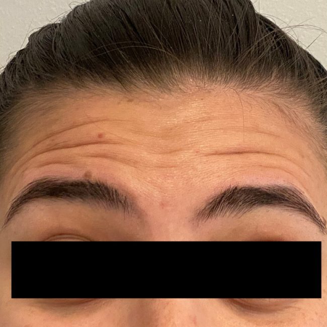 Dysport Before and After - Case 12, Image 1 - Female, age 25 – 34 - Baltimore, MD - Skin Therapeutics Med Spa