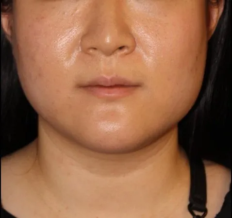 Botox Before and After - Case 10, Image 1 - Female, age 25 – 34 - Baltimore, MD - Skin Therapeutics Med Spa