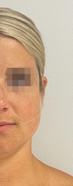 Botox Before and After - Case 11, Image 1 - Female, age 25 – 34 - Baltimore, MD - Skin Therapeutics Med Spa