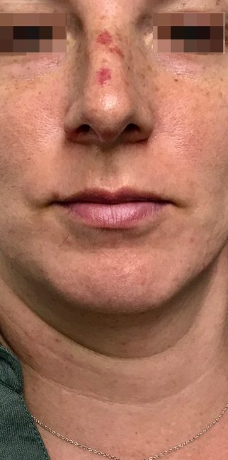 IPL Before and After - Case -1, Image 1 - Female, age 35 – 44 - Baltimore, MD - Skin Therapeutics Med Spa