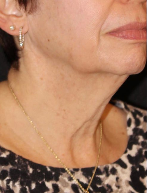 RF Microneedling Before and After - Case -1, Image 1 - Female, age 45 – 54 - Baltimore, MD - Skin Therapeutics Med Spa