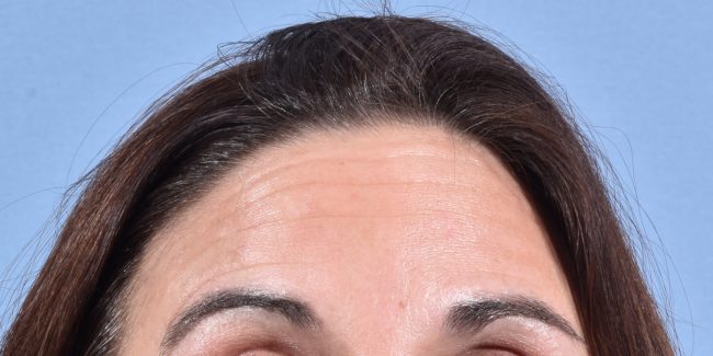 Dysport Before and After - Case 4, Image 3 - Female, age 25 – 34 - Baltimore, MD - Skin Therapeutics Med Spa