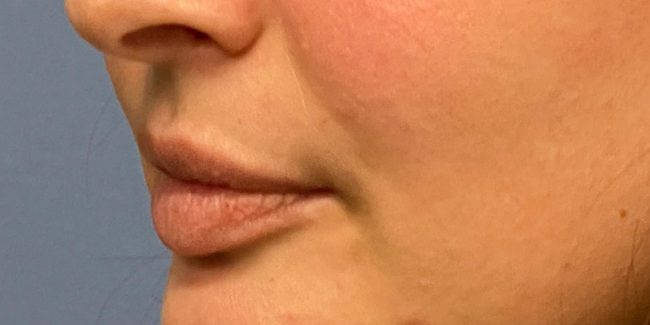 Fillers Before and After - Case 7, Image 3 - Female, age 18 – 24 - Baltimore, MD - Skin Therapeutics Med Spa