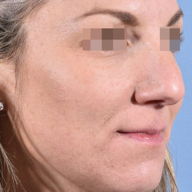 Fillers Before and After - Case 8, Image 3 - Female, age 25 – 34 - Baltimore, MD - Skin Therapeutics Med Spa