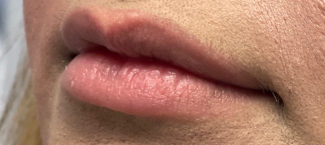 Fillers Before and After - Case 10, Image 3 - Female, age 25 – 34 - Baltimore, MD - Skin Therapeutics Med Spa