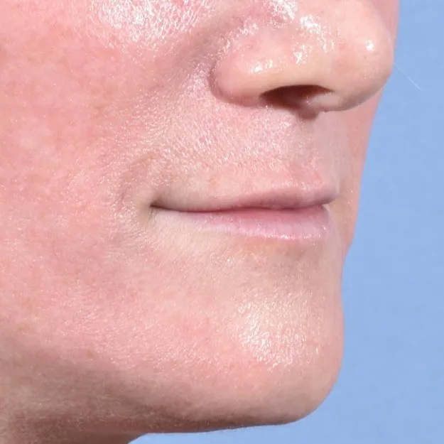 Fillers Before and After - Case 11, Image 3 - Female, age 35 – 44 - Baltimore, MD - Skin Therapeutics Med Spa