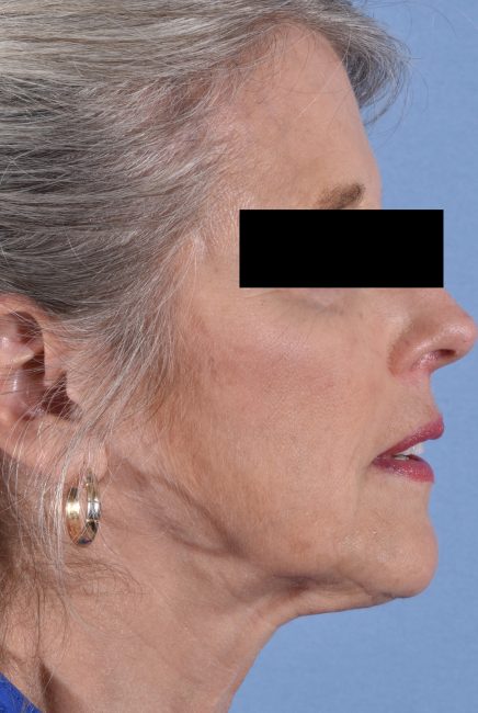 Fillers Before and After - Case 13, Image 3 - Female, age 55 – 64 - Baltimore, MD - Skin Therapeutics Med Spa