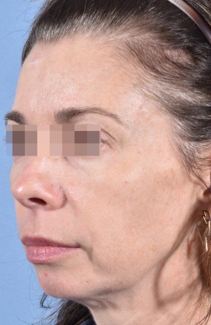 Fillers Before and After - Case 14, Image 3 - Female, age 35 – 44 - Baltimore, MD - Skin Therapeutics Med Spa