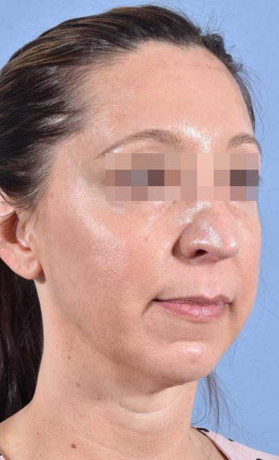 Fillers Before and After - Case 15, Image 3 - Female, age 35 – 44 - Baltimore, MD - Skin Therapeutics Med Spa