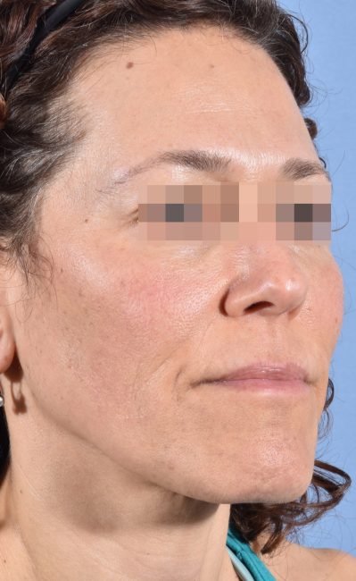 Fillers Before and After - Case 16, Image 3 - Female, age 35 – 44 - Baltimore, MD - Skin Therapeutics Med Spa