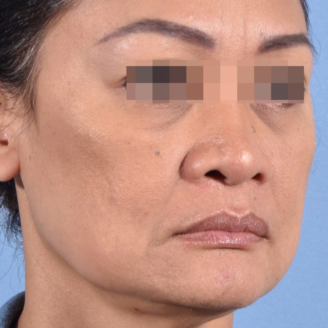 Fillers Before and After - Case 17, Image 3 - Female, age 35 – 44 - Baltimore, MD - Skin Therapeutics Med Spa