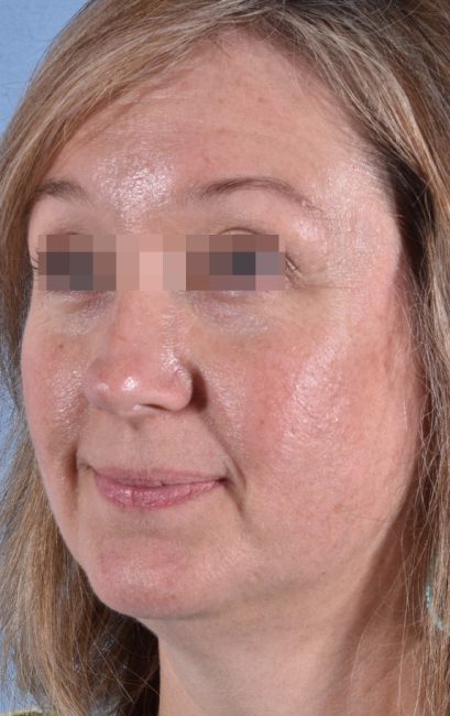 Fillers Before and After - Case 18, Image 3 - Female, age 35 – 44 - Baltimore, MD - Skin Therapeutics Med Spa