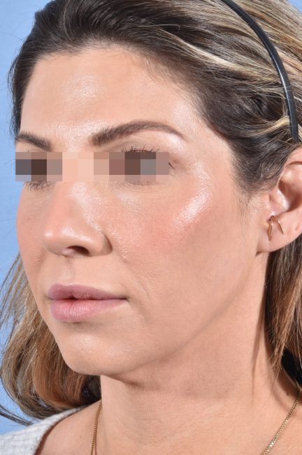 Fillers Before and After - Case 19, Image 3 - Female, age 25 – 34 - Baltimore, MD - Skin Therapeutics Med Spa