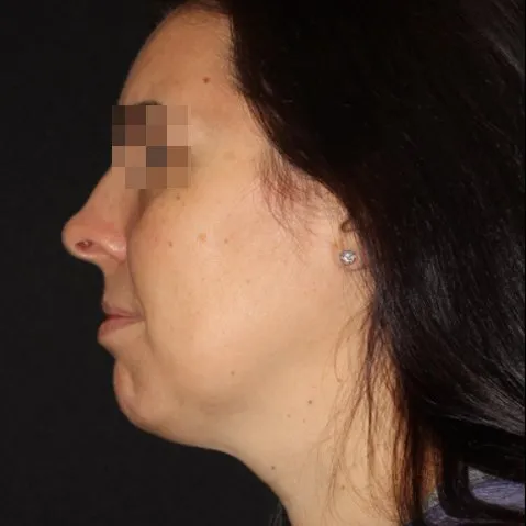 Fillers Before and After - Case 21, Image 3 - Female, age 25 – 34 - Baltimore, MD - Skin Therapeutics Med Spa