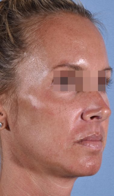 Fillers Before and After - Case 26, Image 3 - Female, age 25 – 34 - Baltimore, MD - Skin Therapeutics Med Spa