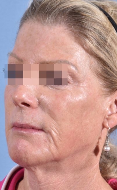 Fillers Before and After - Case 27, Image 3 - Female, age 45 – 54 - Baltimore, MD - Skin Therapeutics Med Spa