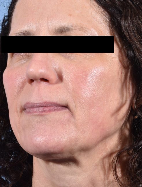 Fillers Before and After - Case 28, Image 3 - Female, age 45 – 54 - Baltimore, MD - Skin Therapeutics Med Spa