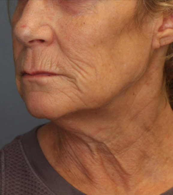 Fillers Before and After - Case 31, Image 3 - Female, age 45 – 54 - Baltimore, MD - Skin Therapeutics Med Spa