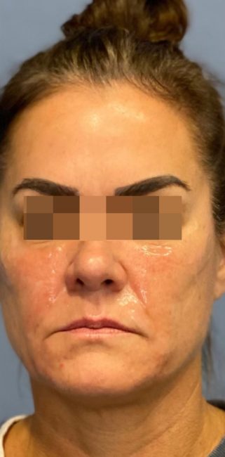 Fillers Before and After - Case 33, Image 3 - Female, age 35 – 44 - Baltimore, MD - Skin Therapeutics Med Spa