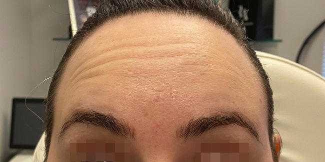 Dysport Before and After - Case 6, Image 3 - Female, age 25 – 34 - Baltimore, MD - Skin Therapeutics Med Spa