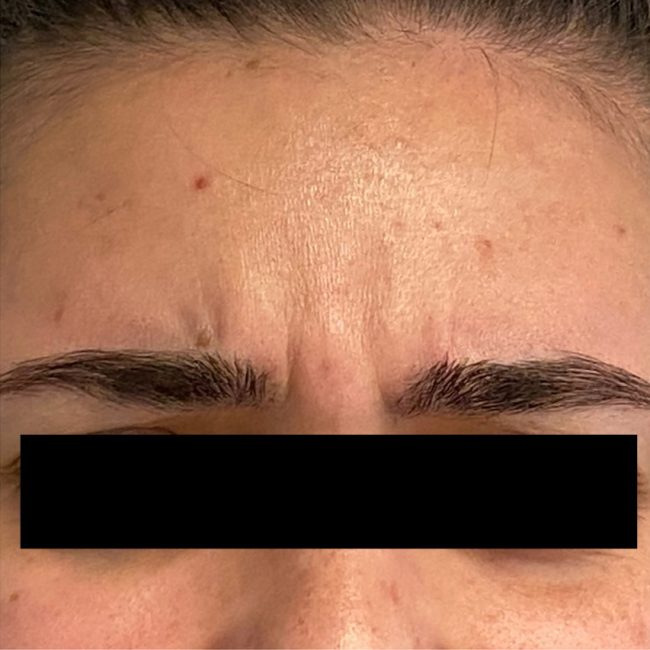 Dysport Before and After - Case 12, Image 3 - Female, age 25 – 34 - Baltimore, MD - Skin Therapeutics Med Spa