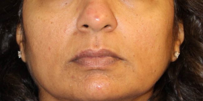 RF Microneedling Before and After - Case 2, Image 1 - Female, age 35 – 44 - Baltimore, MD - Skin Therapeutics Med Spa