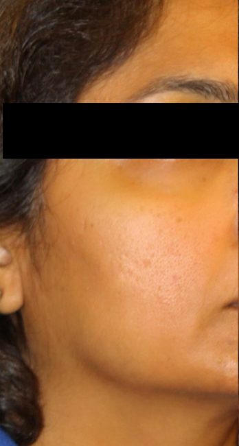 RF Microneedling Before and After - Case 3, Image 1 - Female, age 35 – 44 - Baltimore, MD - Skin Therapeutics Med Spa