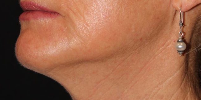 RF Microneedling Before and After - Case 4, Image 4 - Female, age 55 – 64 - Baltimore, MD - Skin Therapeutics Med Spa