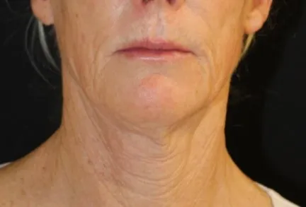 RF Microneedling Before and After - Case 4, Image 1 - Female, age 55 – 64 - Baltimore, MD - Skin Therapeutics Med Spa