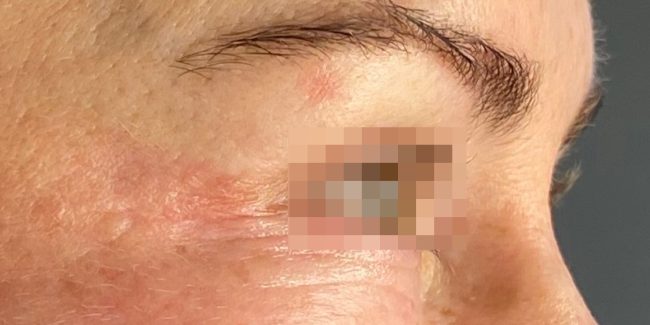 Plasma IQ Before and After - Case 2, Image 1 - Female, age 35 – 44 - Baltimore, MD - Skin Therapeutics Med Spa