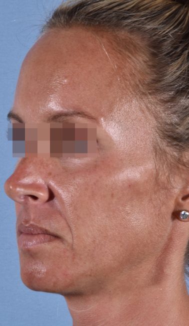 Fillers Before and After - Case 26, Image 5 - Female, age 25 – 34 - Baltimore, MD - Skin Therapeutics Med Spa