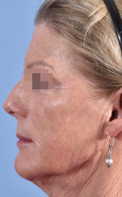 Fillers Before and After - Case 27, Image 5 - Female, age 45 – 54 - Baltimore, MD - Skin Therapeutics Med Spa