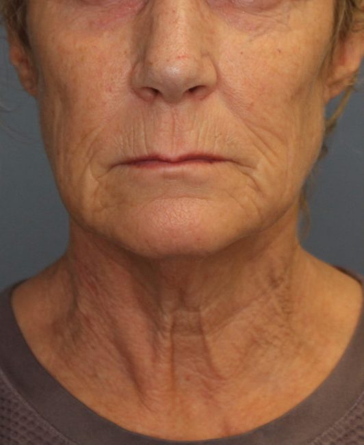 Fillers Before and After - Case 31, Image 5 - Female, age 45 – 54 - Baltimore, MD - Skin Therapeutics Med Spa