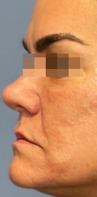 Fillers Before and After - Case 33, Image 5 - Female, age 35 – 44 - Baltimore, MD - Skin Therapeutics Med Spa