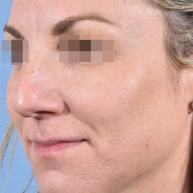 Fillers Before and After - Case 8, Image 5 - Female, age 25 – 34 - Baltimore, MD - Skin Therapeutics Med Spa